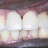 Crowns After